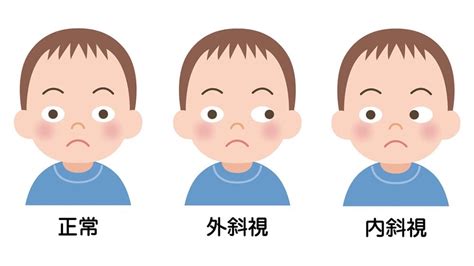 斜視|斜視：どんな症状？原因やリスクは？自分で対処する。